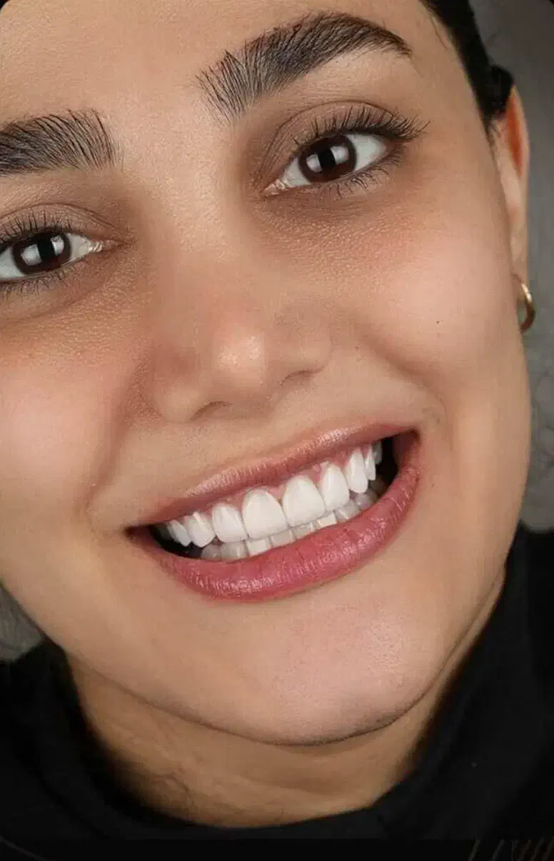 کامپوزیت دندان|خدمات آرایشگری و زیبایی|بوشهر, |دیوار