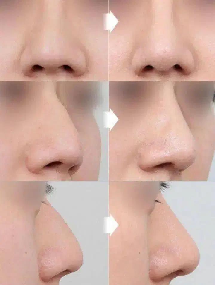 کرم کوچیک کننده بینی|آرایشی، بهداشتی، درمانی|قرقری, |دیوار