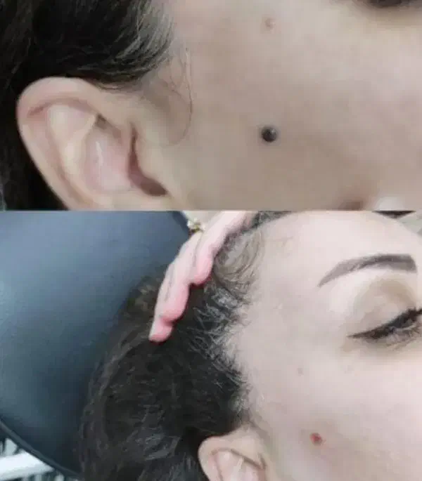 درمان کیست ملیا زیر چشم و برداشتن خال و زگیل|خدمات آرایشگری و زیبایی|نیشابور, دارایی|دیوار