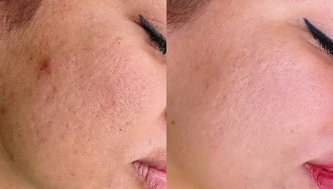 جوانسازی ورفع جای جوش بامیکرونیدلینگ کلینیک زیبایی|خدمات آرایشگری و زیبایی|اصفهان, جلفا|دیوار