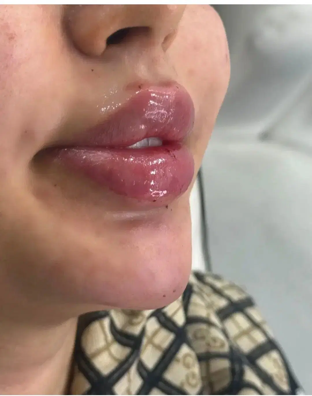 ژل،فیلربادی،بیکینی،بوتاکسprp لیفت صورت|خدمات زیبایی و سلامت|تبریز, |دیوار