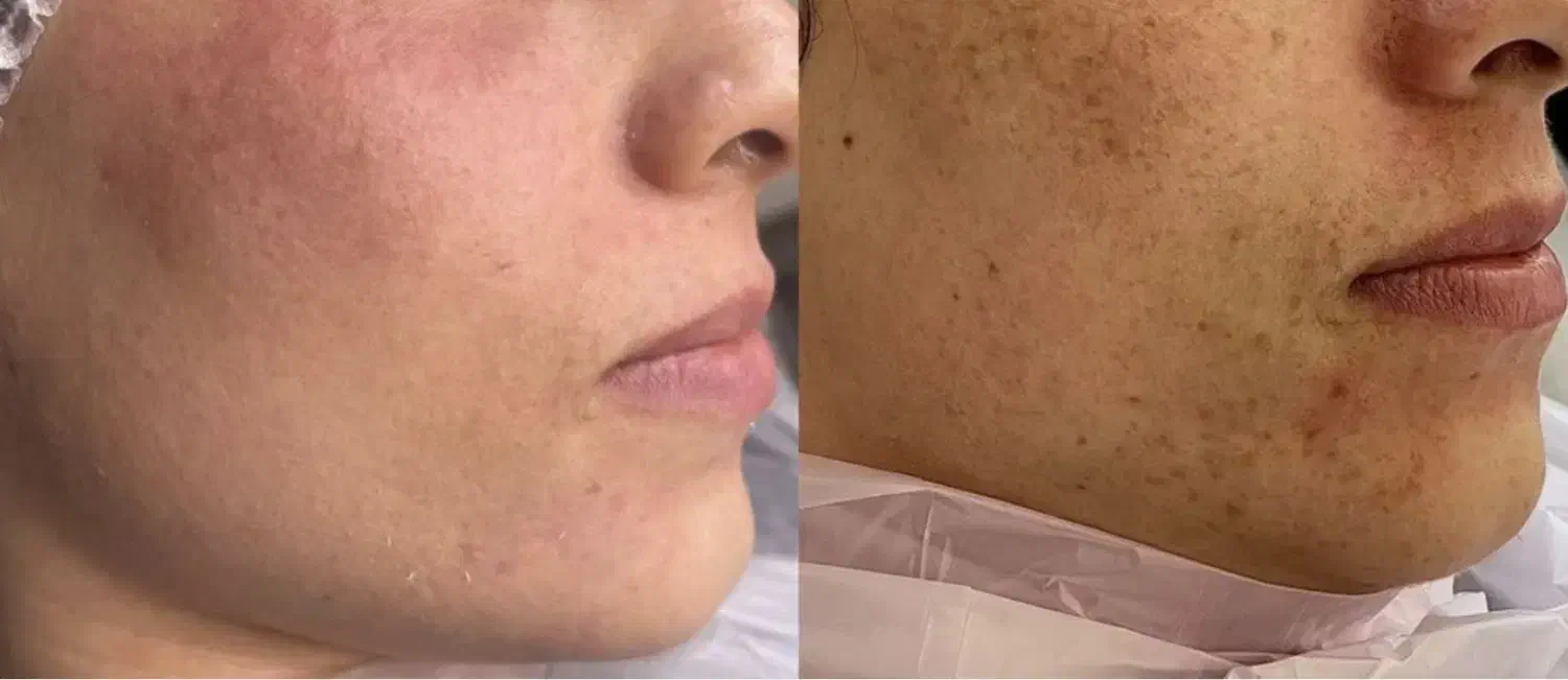 مدل برای درمان لک و اکنه(جوش) و اسکار وتیرگی بدن|خدمات آرایشگری و زیبایی|کاشان, فاز ۱ ناجی آباد|دیوار