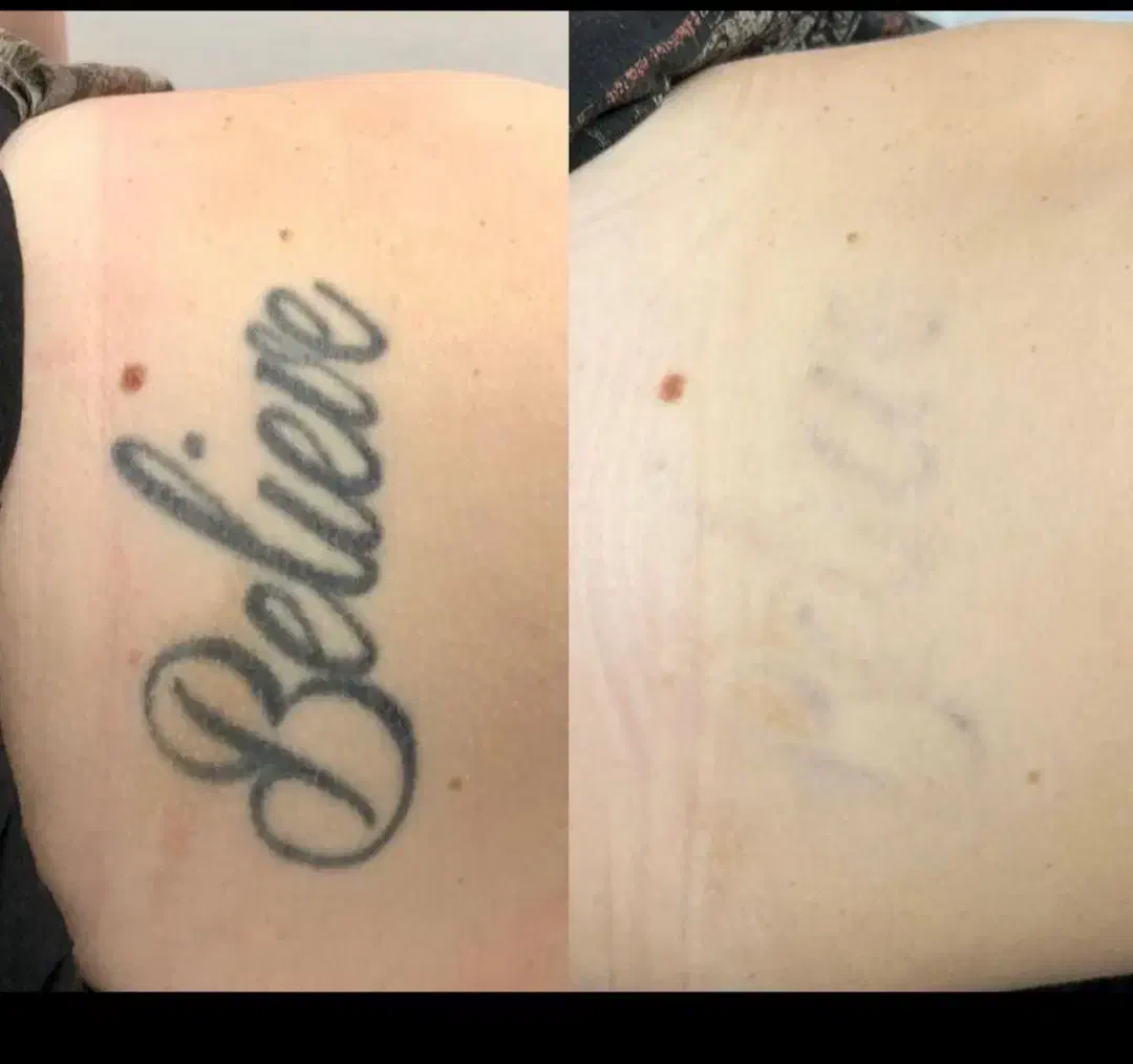 لیزر تتو های قدیمی تتوی صورت و بدن فقط ۵۰۰|خدمات آرایشگری و زیبایی|فولادشهر, C3|دیوار