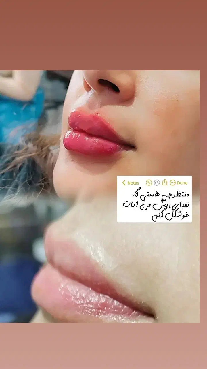 فیلر وبوتاکس|خدمات آرایشگری و زیبایی|گرگان, |دیوار