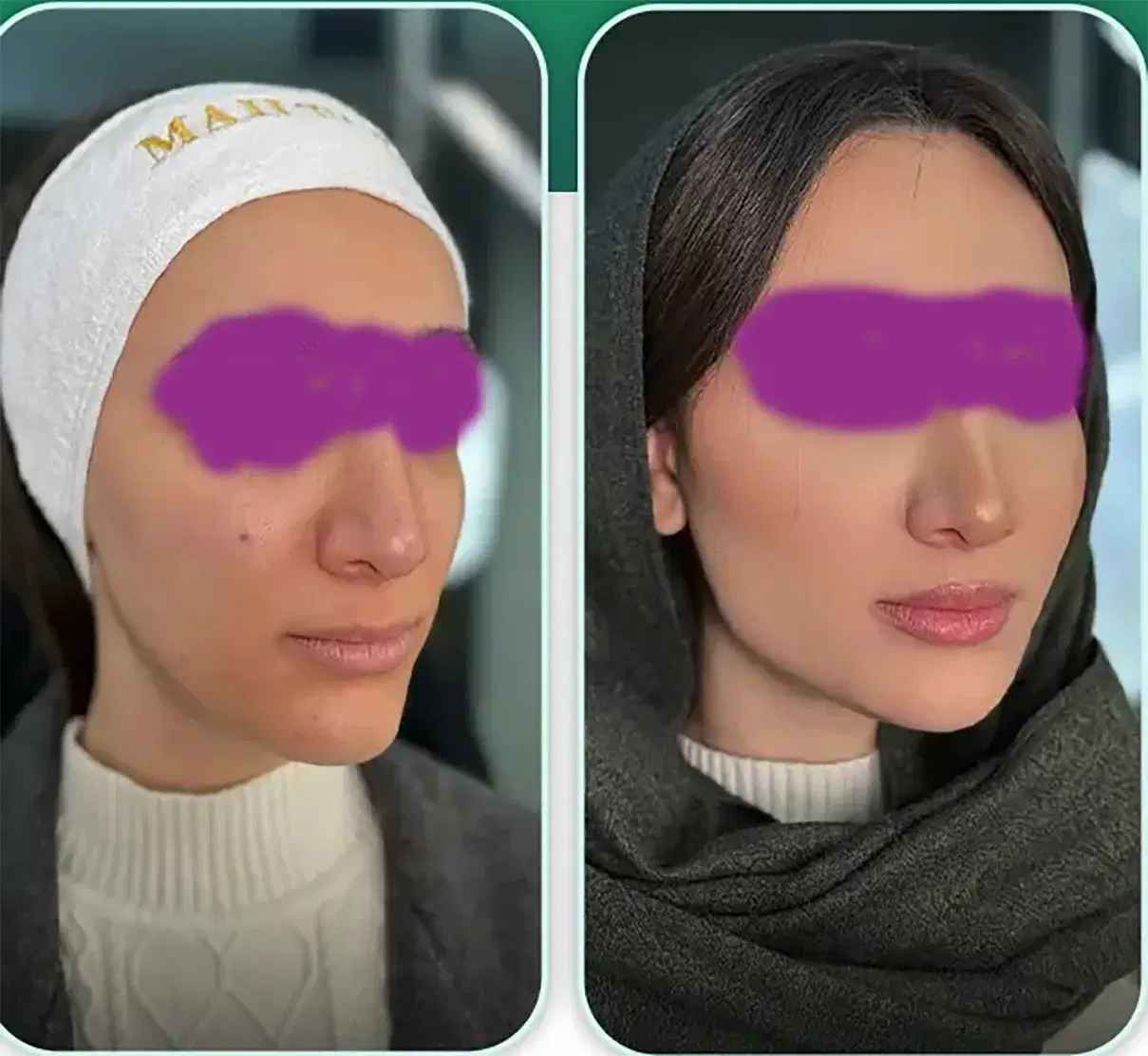 بایو فیلر متد اروپایی کلینیک فرحزاد|خدمات زیبایی و سلامت|اصفهان, عباسآباد|دیوار