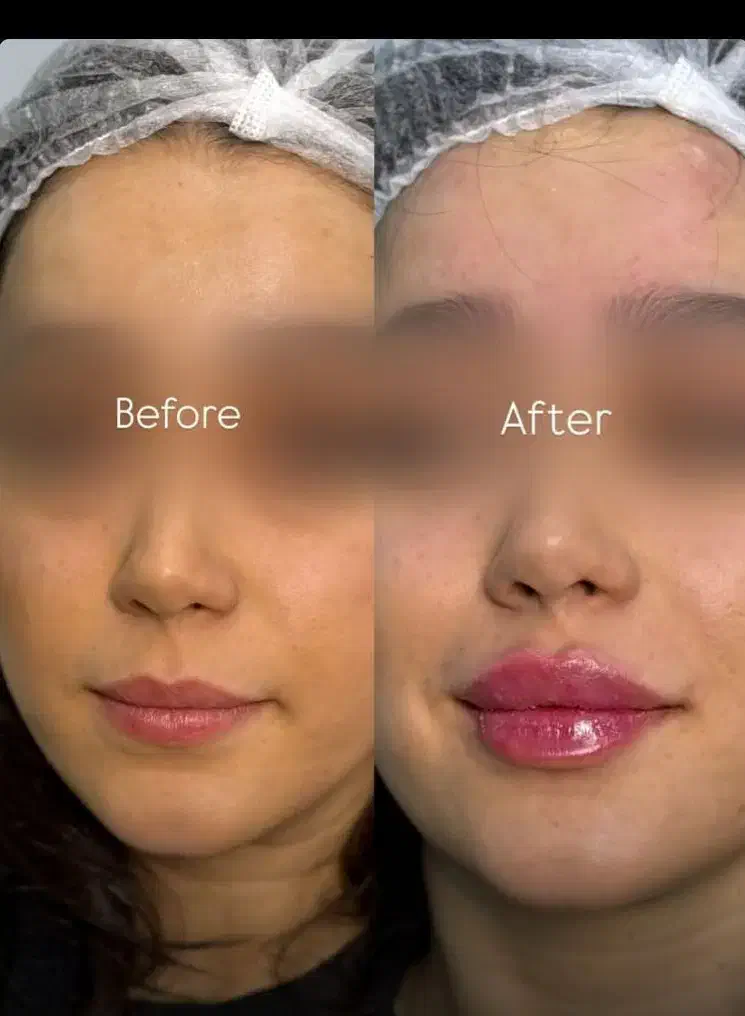 لیزر،بوتاکس، مزوتراپی، فیلر،وایتینگ|خدمات آرایشگری و زیبایی|هشترود, |دیوار