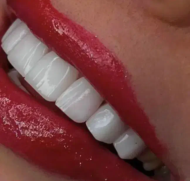 کامپوزیت دندان.لمینت دندانپزشکی. ایمپلنت.عصب کشی|خدمات آرایشگری و زیبایی|تهران, تهرانپارس جنوبی|دیوار