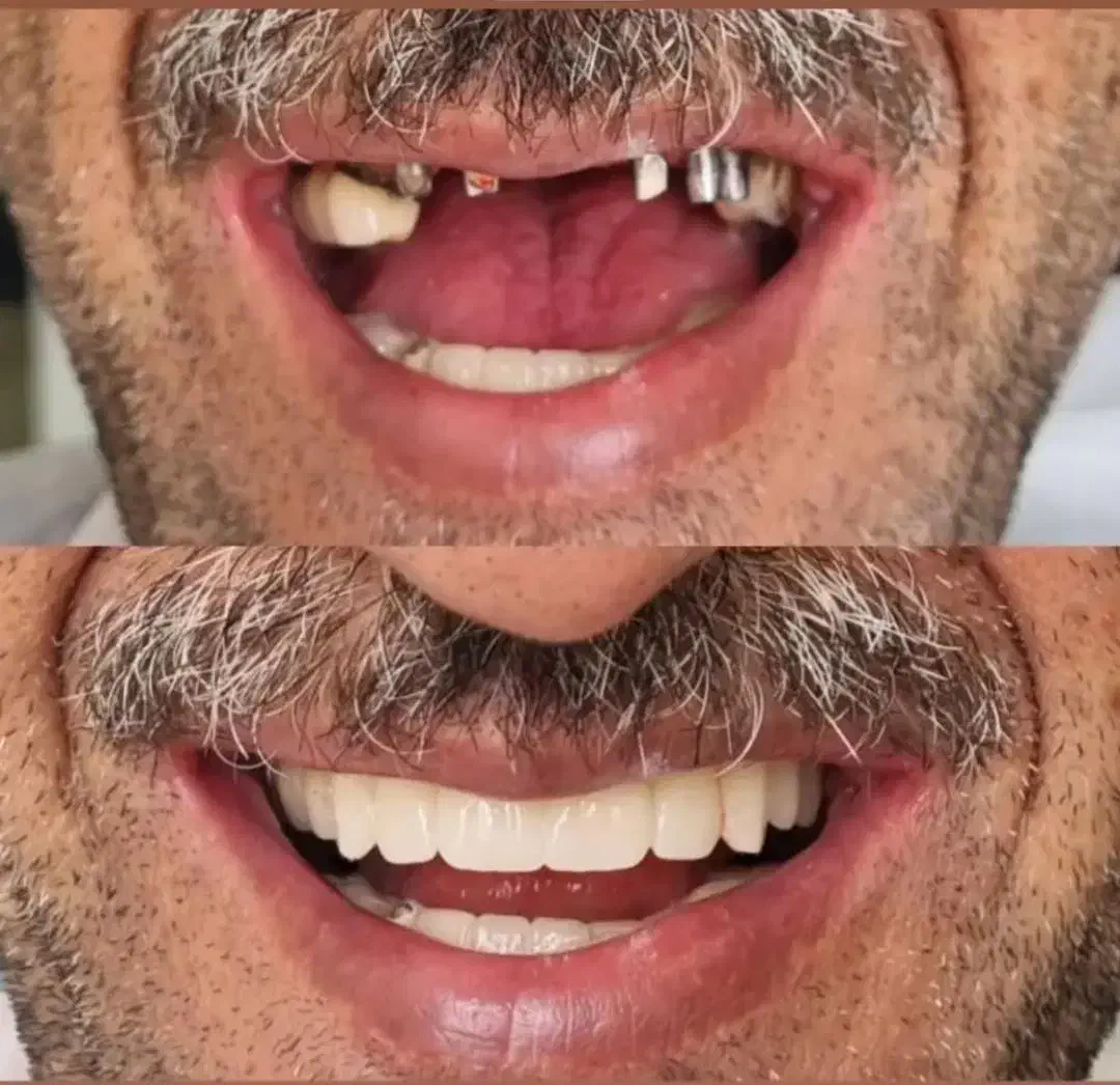 کامپوزیت دندانپزشکی تخفیفه ویژه اقساط چکی|خدمات آرایشگری و زیبایی|تهران, شهرک ولیعصر جنوبی|دیوار