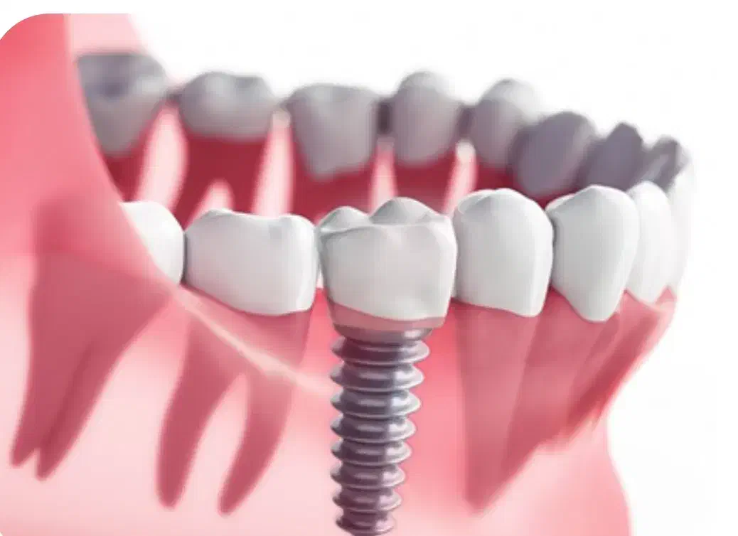 جشنواره ایمپلنت در عظیمیه کرج/فرصت محدود/ضمانتی|خدمات آرایشگری و زیبایی|هشتگرد, شهرک صنعتی هشتگرد|دیوار