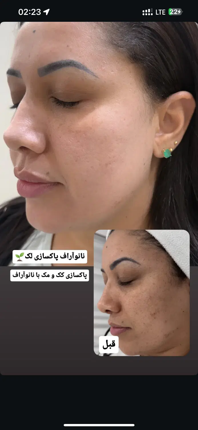 رفع کک و مک و پاک کردن تتو|خدمات زیبایی و سلامت|تهران, فردوس|دیوار