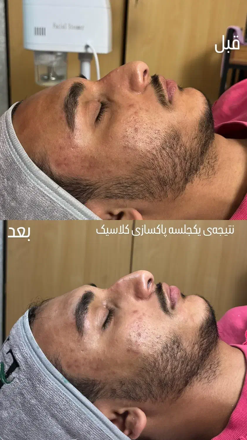 فیشال و پاکسازی تخصصی و کلینیکال پوست آقایان|خدمات آرایشگری و زیبایی|شیراز, قدوسی شرقی|دیوار