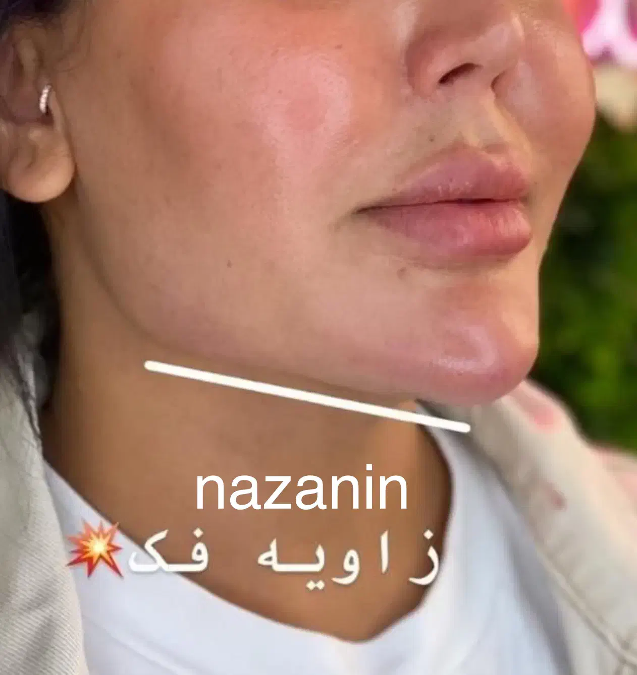 مطب گرگان عدالت ۱۳ بوتاکس ۸۰۰ ژل۱ تومان توسط پزشک|خدمات آرایشگری و زیبایی|گرگان, |دیوار