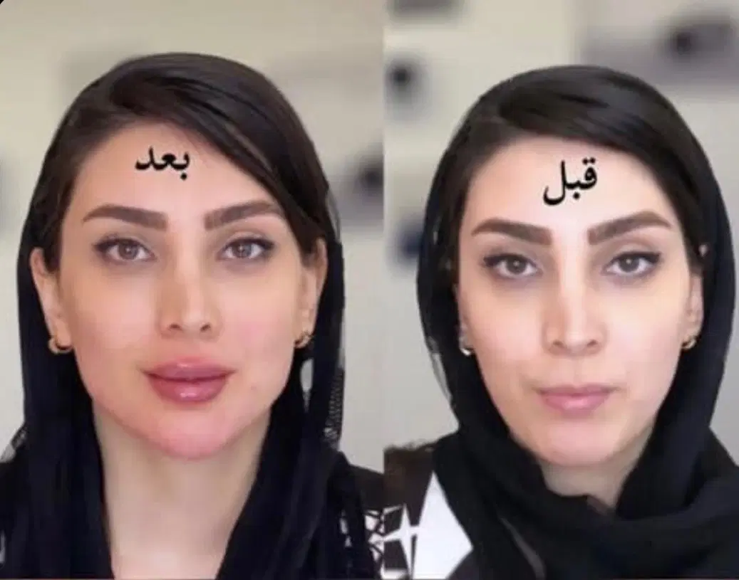 فیلر لب و بوتاکس با پنجاه درصد تخفیف|خدمات زیبایی و سلامت|تهران, صادقیه|دیوار