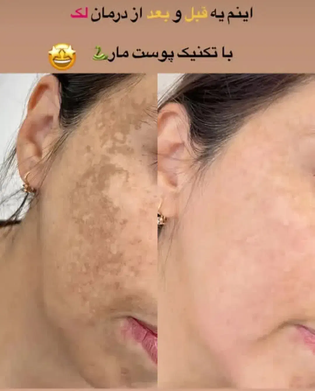 من اسکار،ولک پوستتو درمان میکنم بدون سوزن ودرد|خدمات آرایشگری و زیبایی|کاشان, دشت چال|دیوار