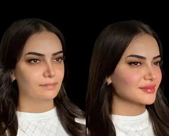 ژل فیلر بوتاکس گونه لب چانه و غیره ۱۸۰۰|خدمات آرایشگری و زیبایی|زاهدان, |دیوار