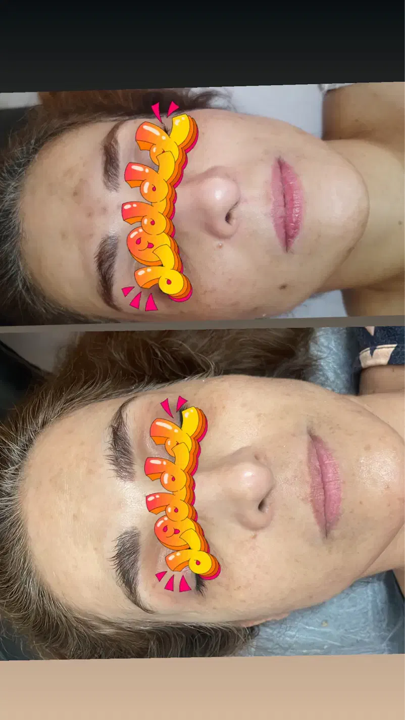 درمان قطعی لک و جوش در کوتاهترین زمان|خدمات آرایشگری و زیبایی|مشهد, چهارچشمه|دیوار