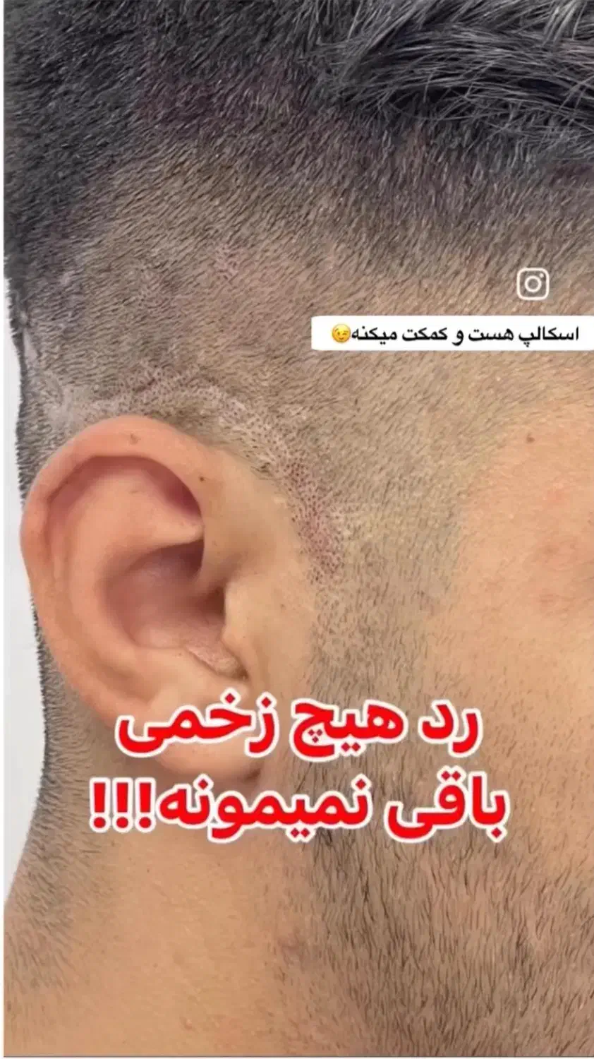 میکرو اسکالپ سر|خدمات آرایشگری و زیبایی|شهریار, شهرک وائین|دیوار