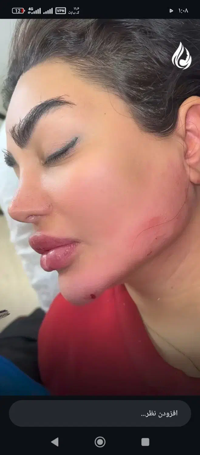 ژل و بوتاکس|خدمات آرایشگری و زیبایی|کوهدشت, |دیوار