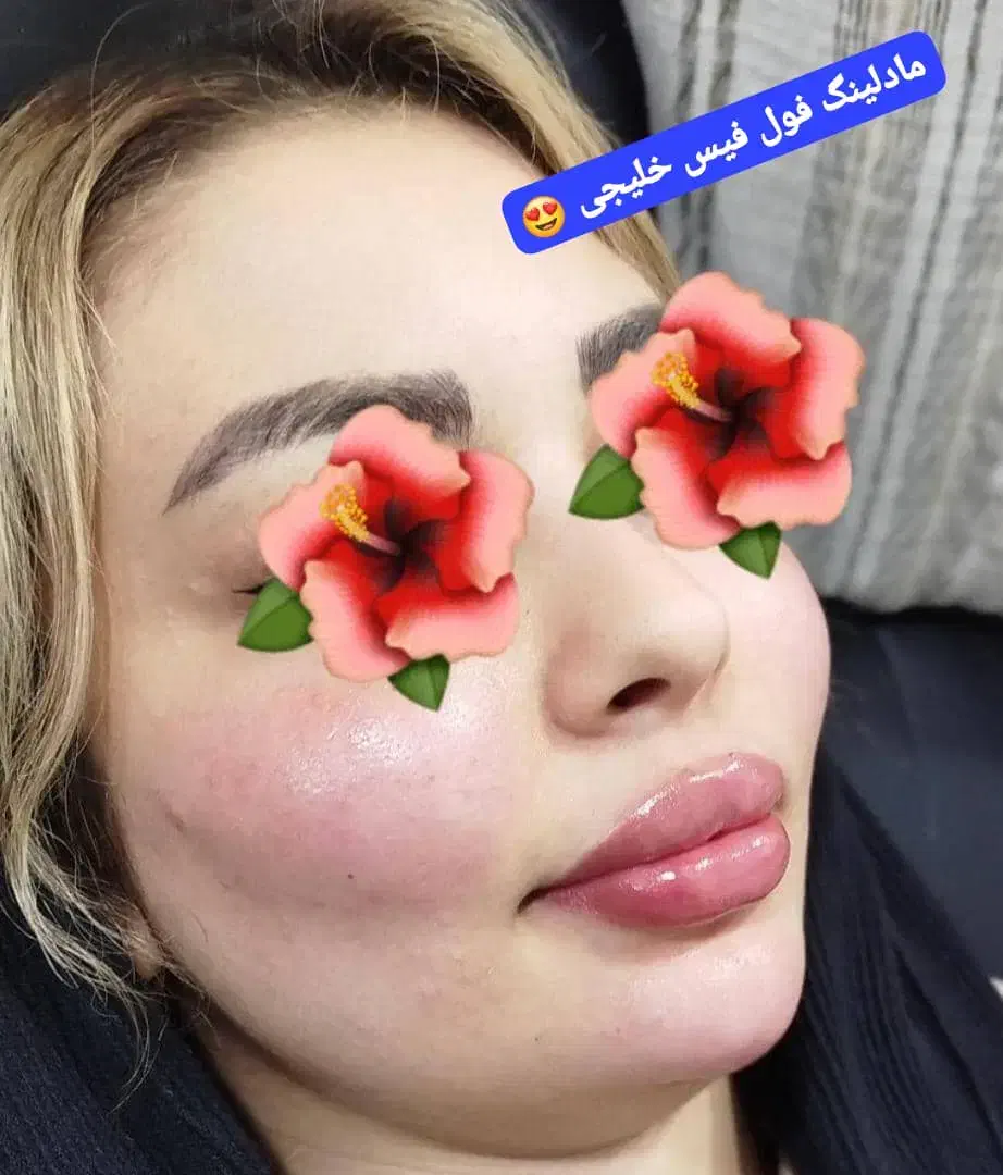 ژل سی سی۵۰۰ پرسینگ، چال گونه|خدمات آرایشگری و زیبایی|اهواز, کمپلو جنوبی|دیوار