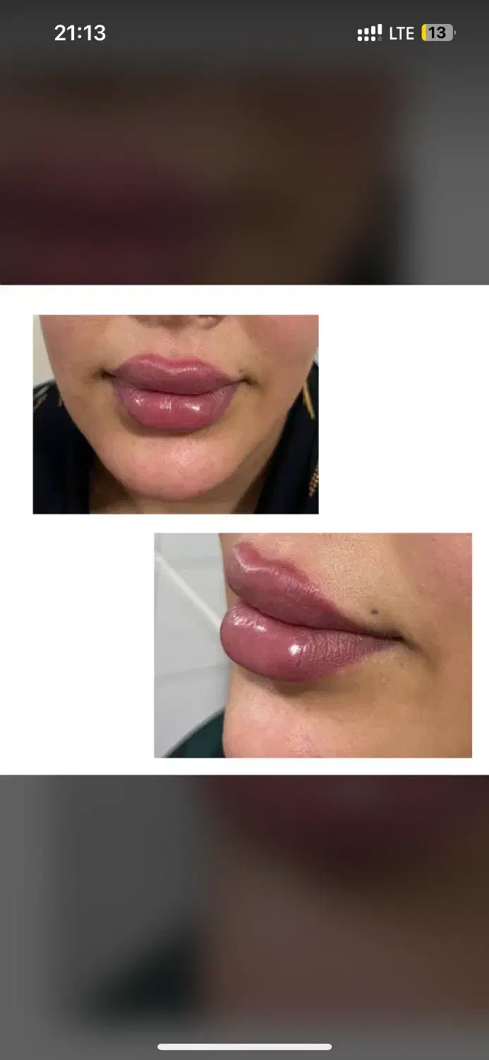 اف ویژه زیبایی تزریق ژل، بوتاکس، پی ار پی|خدمات آرایشگری و زیبایی|اهواز, کمپلو جنوبی|دیوار
