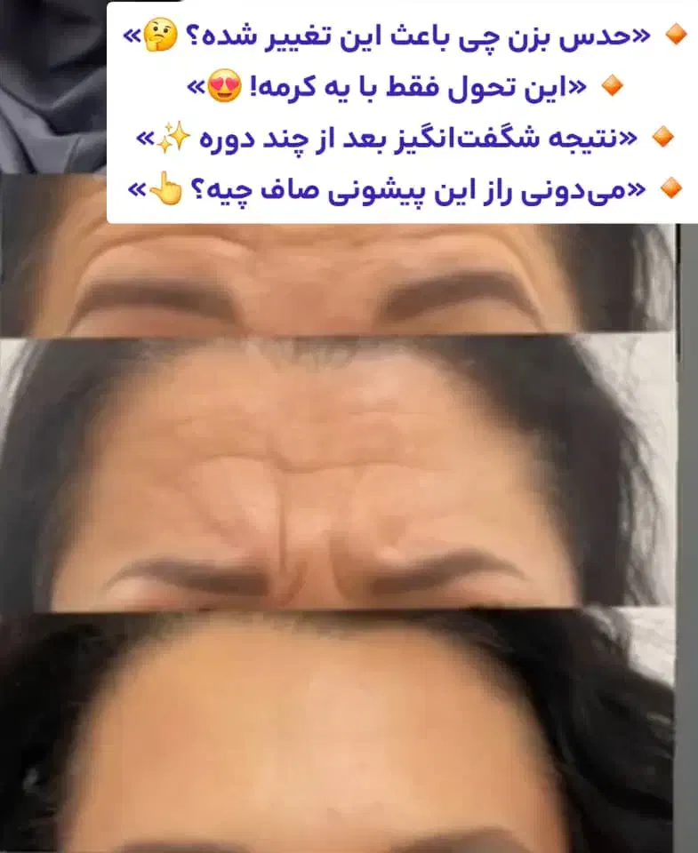 کرم بوتاکس گاتیو|آرایشی، بهداشتی، درمانی|خمام, |دیوار