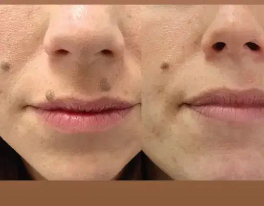 پاکننده زگیل و منگوله|آرایشی، بهداشتی، درمانی|تهران, هلال احمر|دیوار