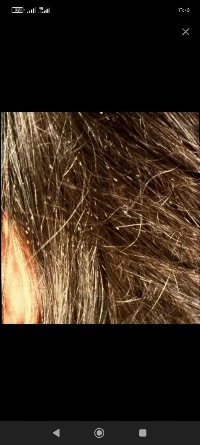 درمان قطعی و تضمینی شپش و تخم شپش بدون بازگشت|آرایشی، بهداشتی، درمانی|اندیمشک, |دیوار