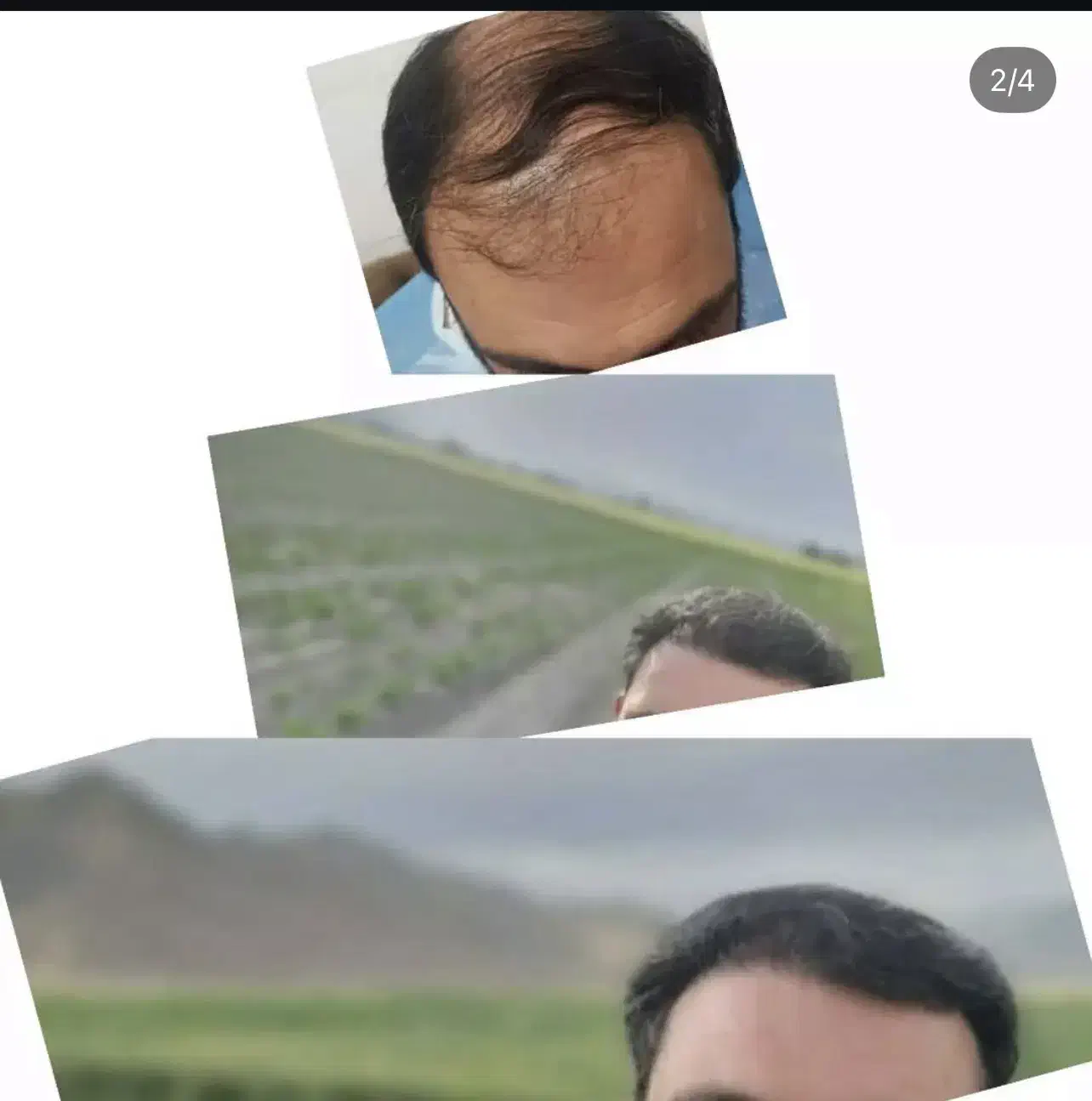 کاشت مو|خدمات آرایشگری و زیبایی|سلماس, |دیوار