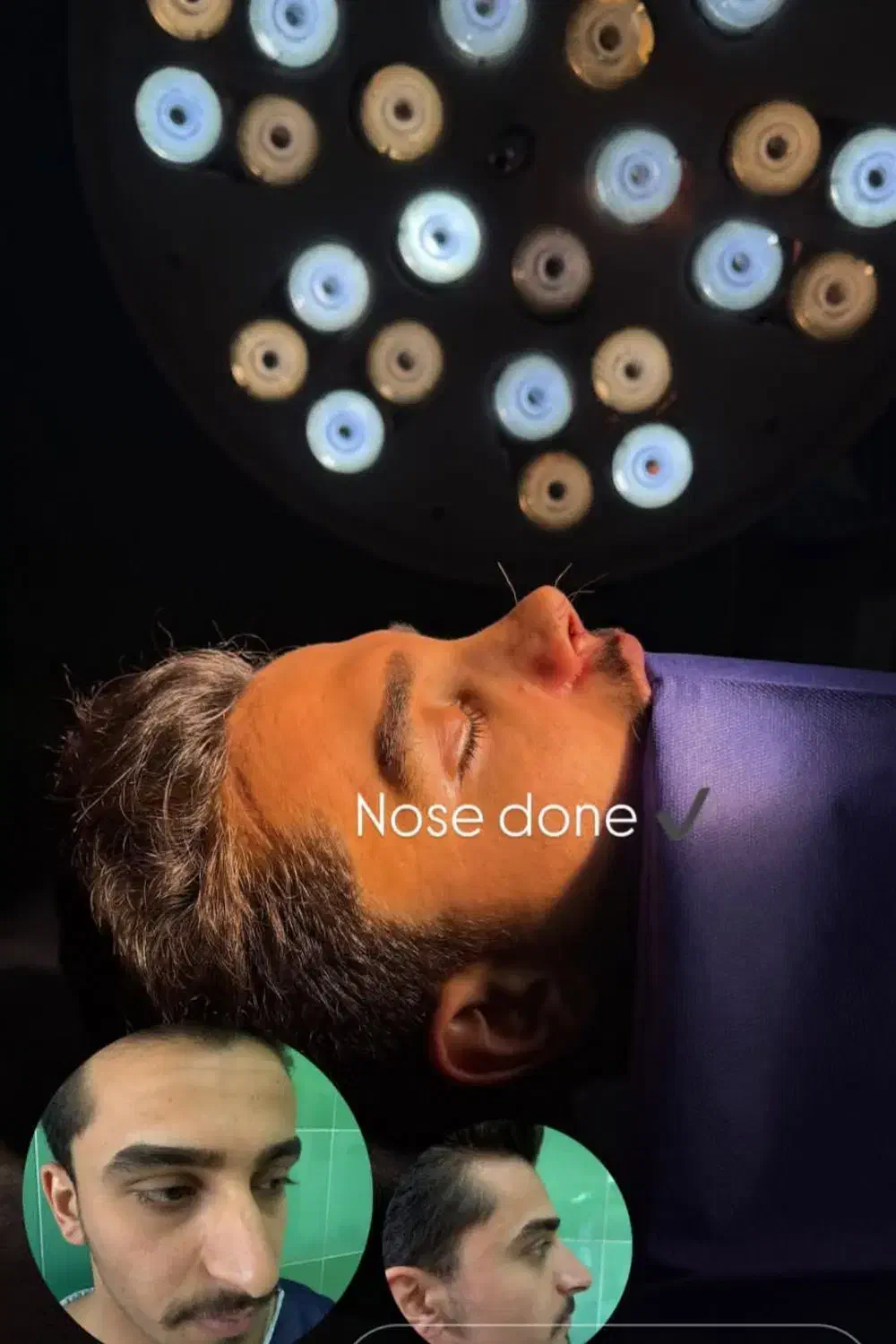 جراحی بینی فقط ۸و۹ آذر فقط۲۹ میلیون تومان|خدمات آرایشگری و زیبایی|فریدونشهر, |دیوار