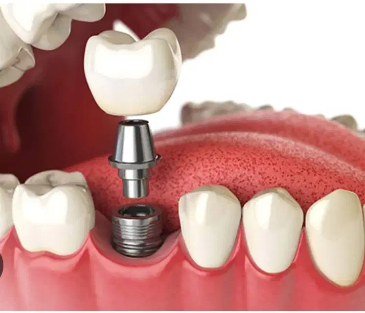 ایمپلنت‌ کره ای ۱۵ میلیون با روکش|خدمات آرایشگری و زیبایی|مشهد, جنت|دیوار