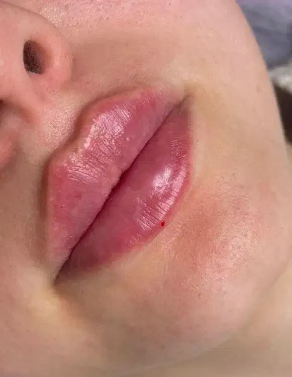 تخفیفات ژل وبوتاکس ومزوژل به مناسبت یلدا|خدمات آرایشگری و زیبایی|قم, زنبیل آباد|دیوار