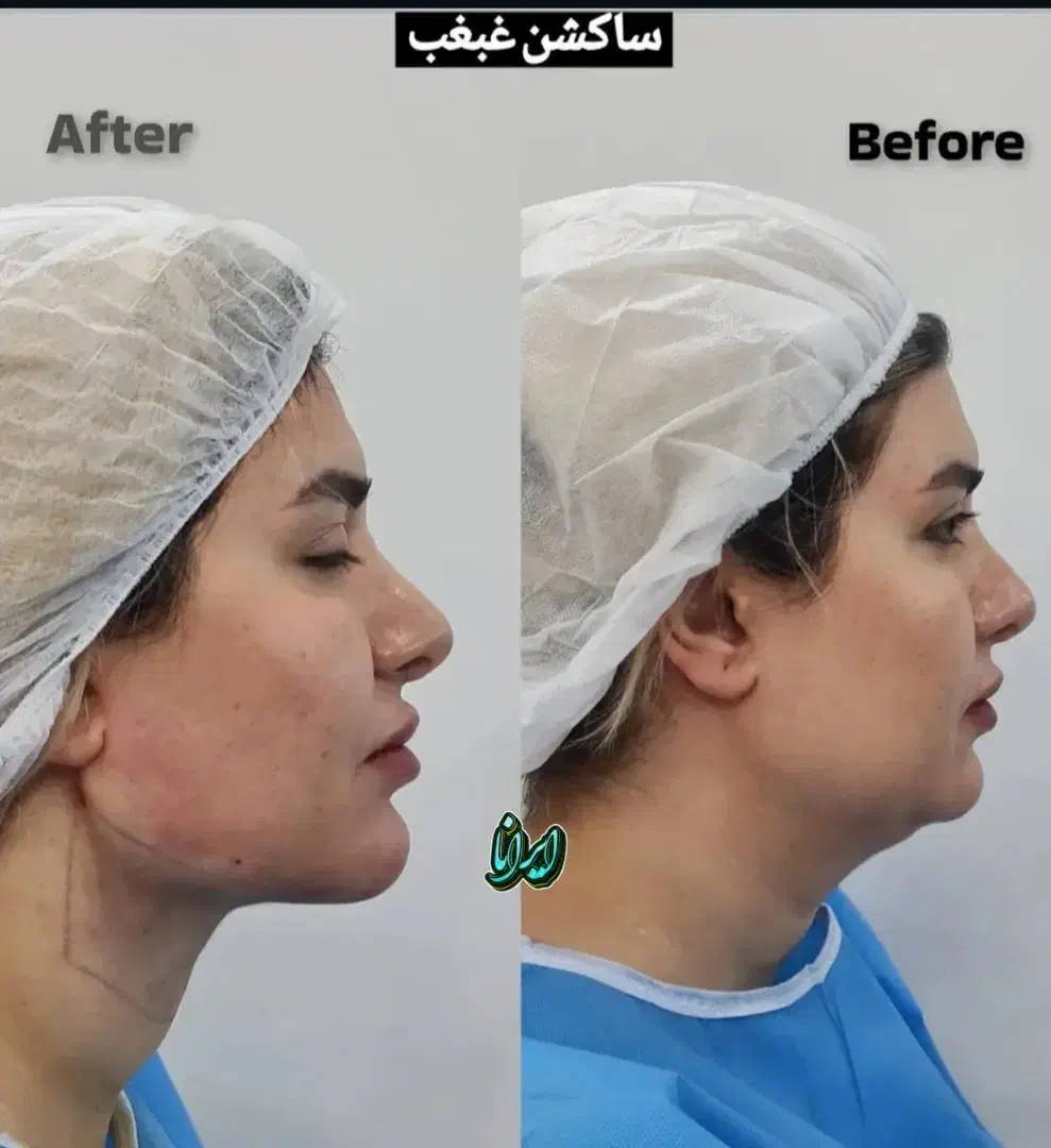 ساکشن غبغب توسط جراح (کلنیک ایرانا)|خدمات آرایشگری و زیبایی|یاسوج, |دیوار