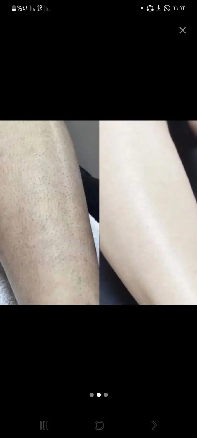 لیزر موهای زائدبدن باقیمت باورنکردنی به مدت محدود|خدمات زیبایی و سلامت|اهواز, پردیس دو|دیوار
