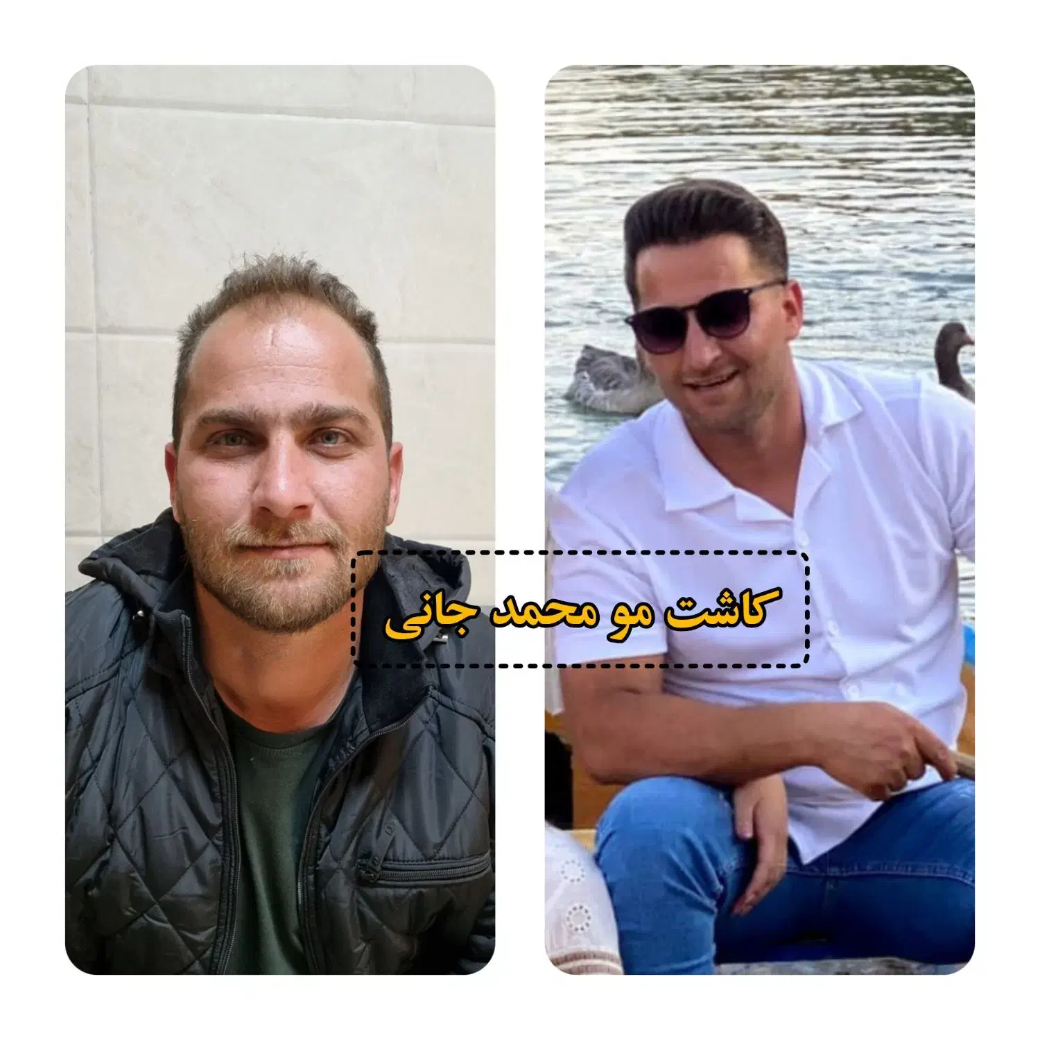 کاشت مو و ابرو و ریش|خدمات آرایشگری و زیبایی|ارسنجان, |دیوار