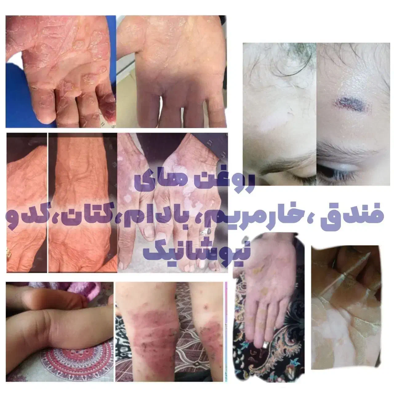 رفع مشکلات پوست و مو|آرایشی، بهداشتی، درمانی|بندر ترکمن, |دیوار