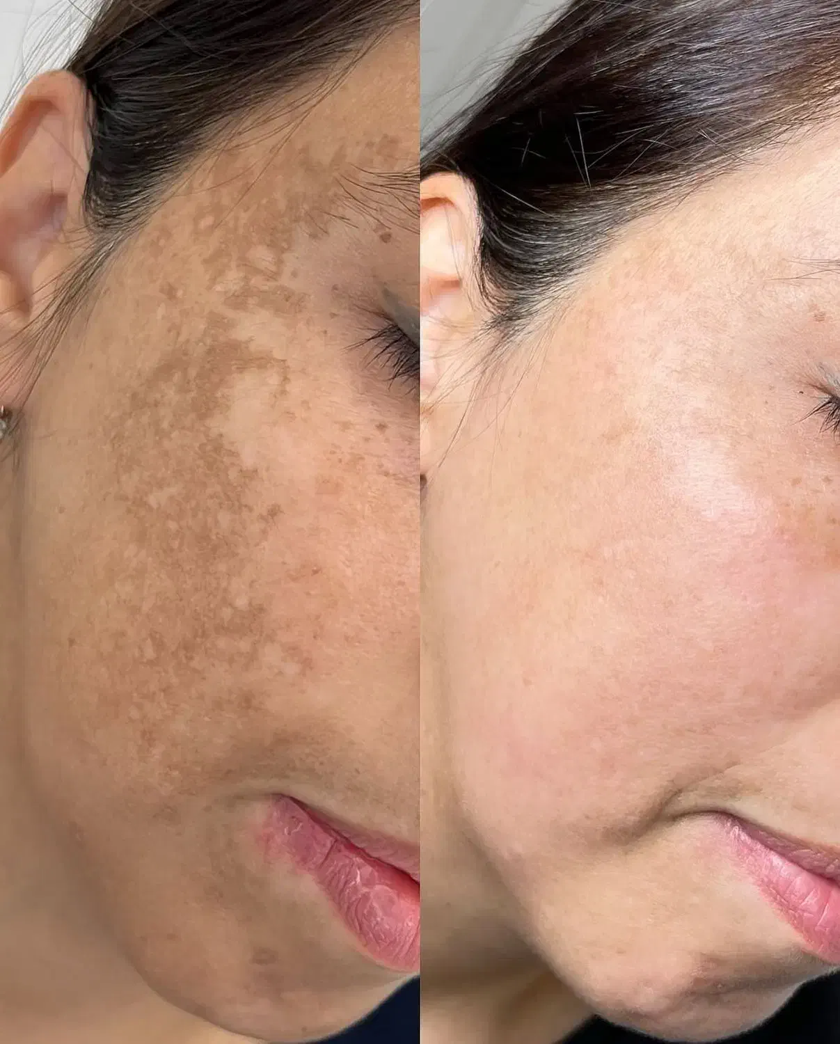 لیزرco2ترکیبی تک جلسه ای هموارساز اف ویژه|خدمات آرایشگری و زیبایی|دوگنبدان, |دیوار