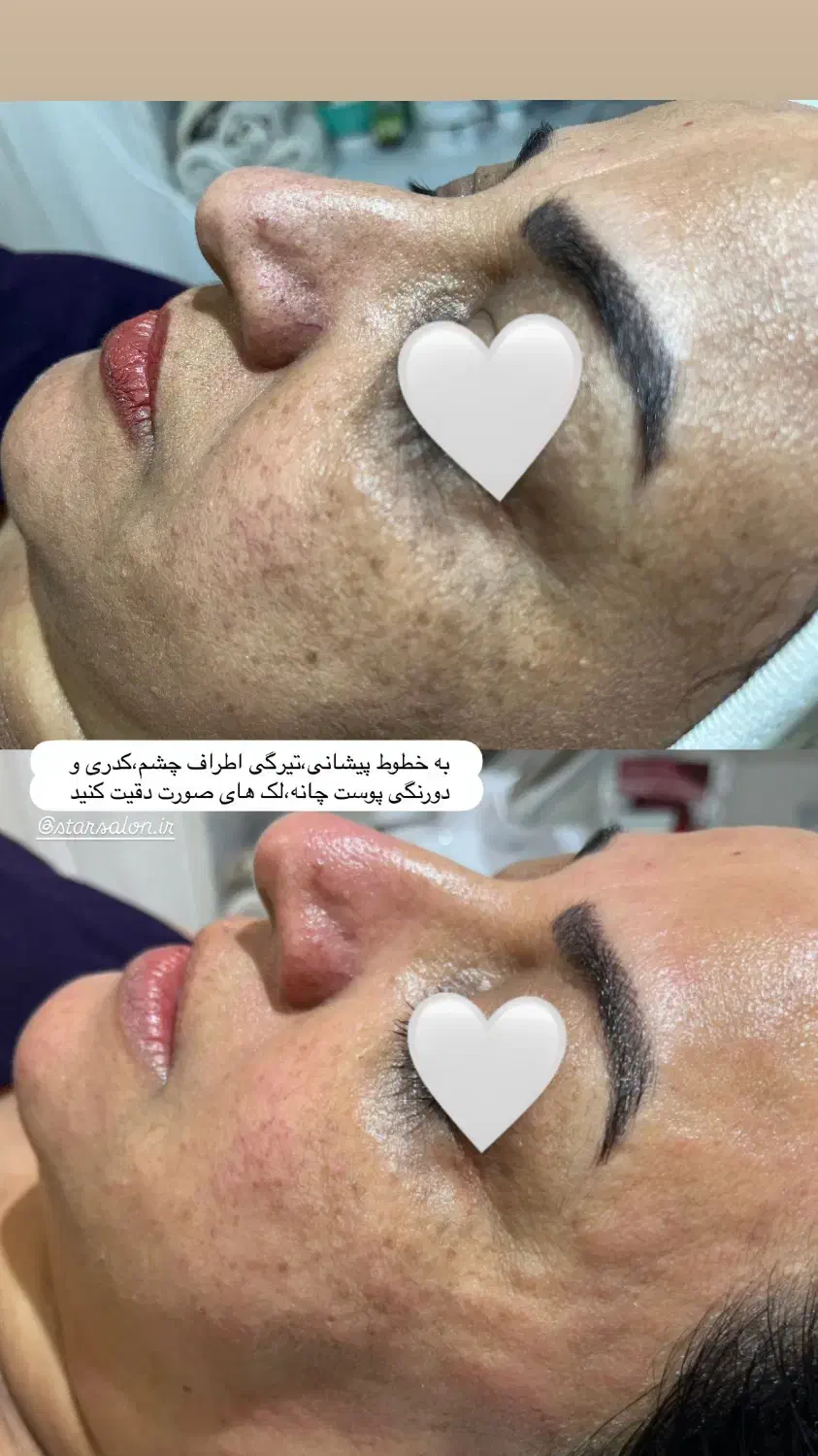 فیشال و پاکسازی صورت|خدمات آرایشگری و زیبایی|شیراز, شهرک فرزانگان|دیوار