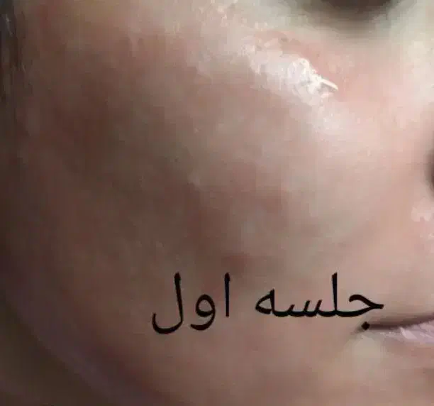 مزو تراپی|خدمات آرایشگری و زیبایی|مشهد, کارگران|دیوار