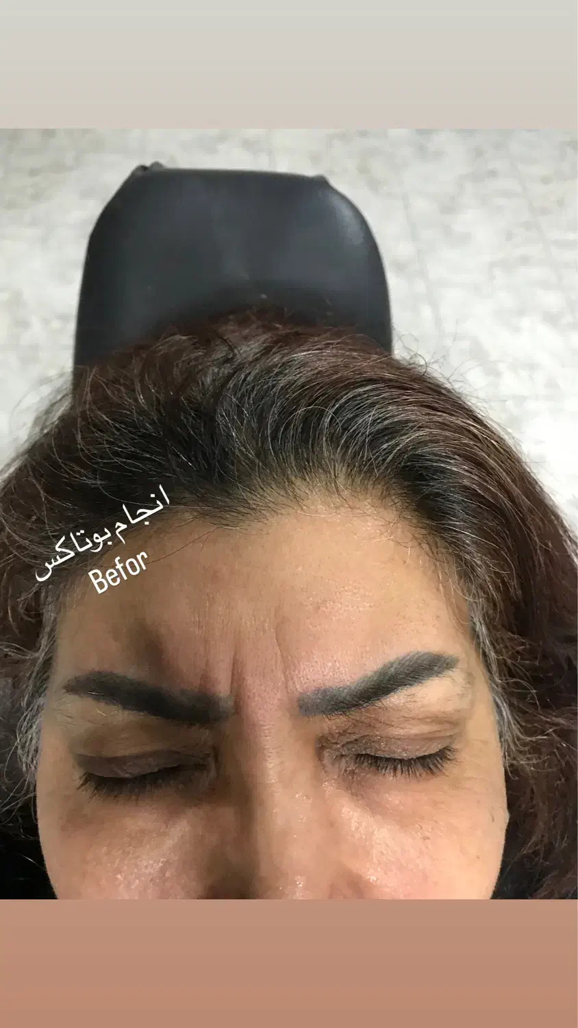 پاکسازی و فیشیال پوست  ازبین بردن لک مخصوص بانوان|خدمات آرایشگری و زیبایی|آمل, |دیوار