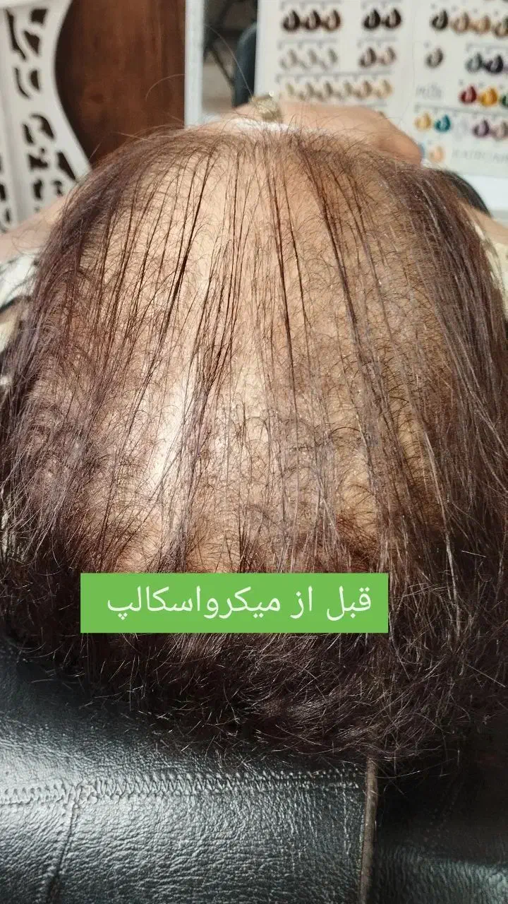 میکرواسکالپ|خدمات آرایشگری و زیبایی|مشهد, صیاد شیرازی|دیوار