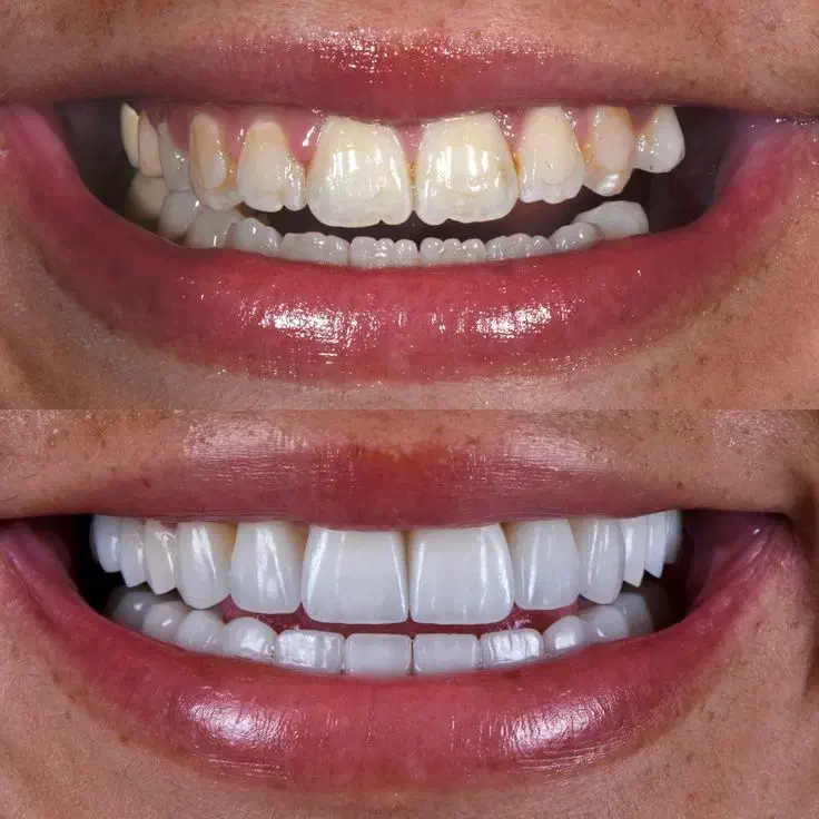 لبخندی رویایی با متریال برند های برتر کامپوزیت|خدمات آرایشگری و زیبایی|یاسوج, |دیوار