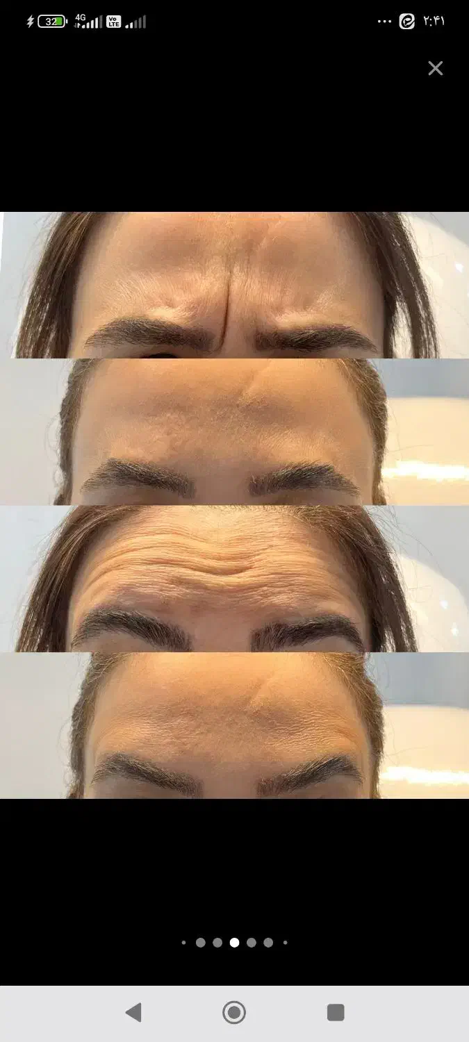 تزریق بوتاکس وژل فقط قیمت مواد|خدمات آرایشگری و زیبایی|اهواز, ۲۴ متری|دیوار