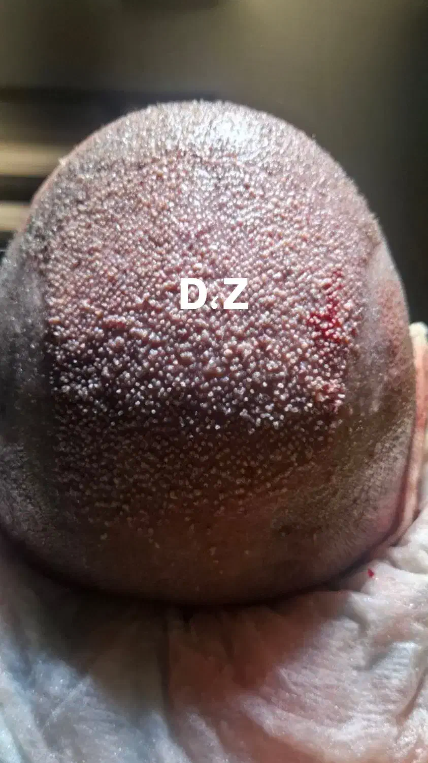 کاشت مو فول تراکم شیرازی در ساری|خدمات آرایشگری و زیبایی|ساری, |دیوار