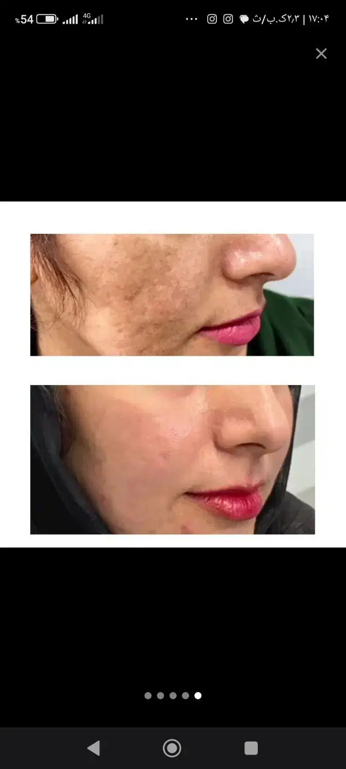 درمان پوست ومو|آرایشی، بهداشتی، درمانی|نهبندان, |دیوار