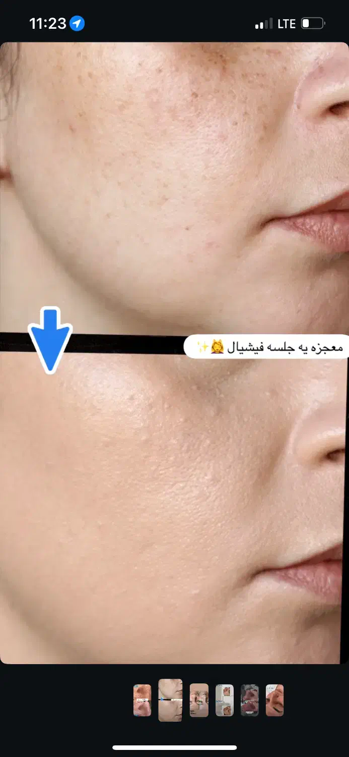 آفر پاکسازی صورت|خدمات آرایشگری و زیبایی|مشهد, ادیب نیشابوری (شهرک غرب)|دیوار