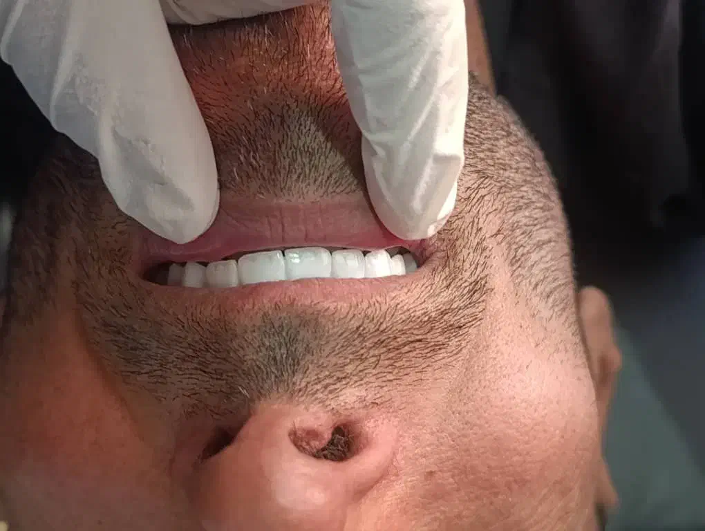 دندانپزشکی کامپوزیت ونیر فقط 9میلیون  اقساطی|خدمات آرایشگری و زیبایی|ارومیه, |دیوار