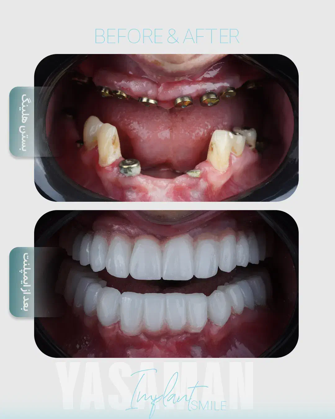 ایمپلنت تخصصی/لمینت/لیفت لثه/کامپوزیت|خدمات آرایشگری و زیبایی|مشهد, سجاد شهر|دیوار