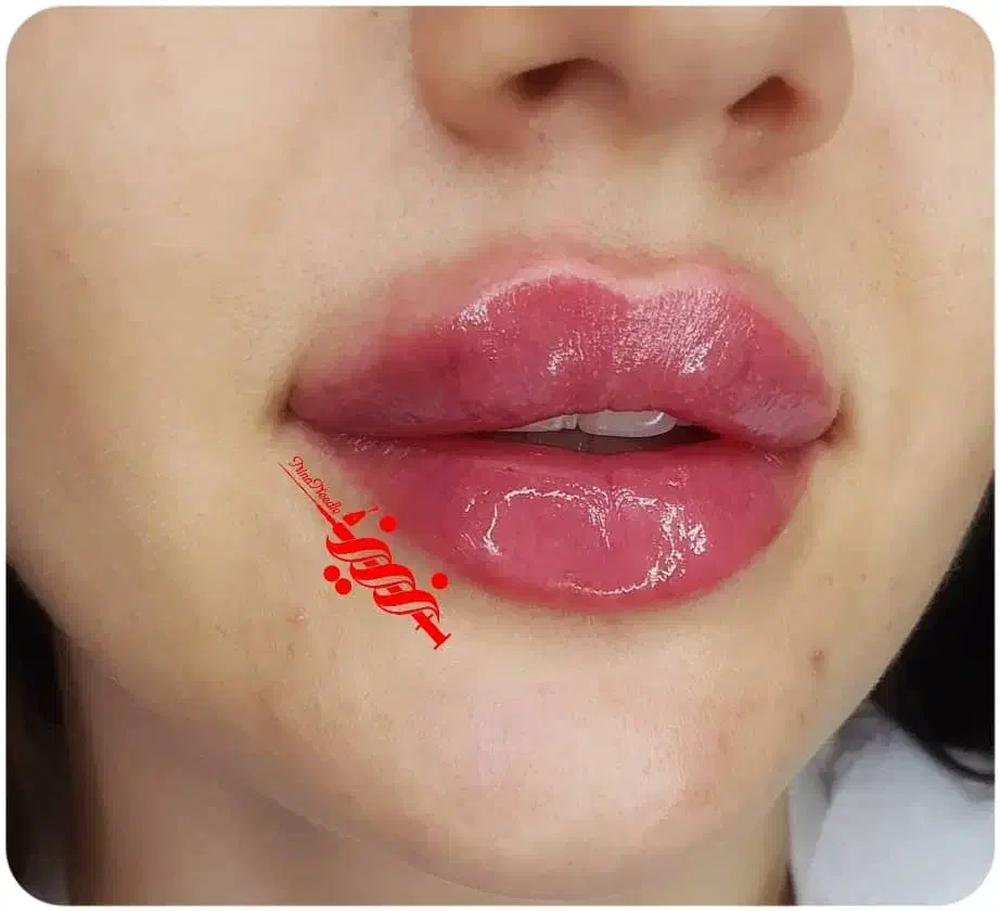 تزریق فیلر ژل و بوتاکس در کلینیک|خدمات آرایشگری و زیبایی|بندرعباس, |دیوار