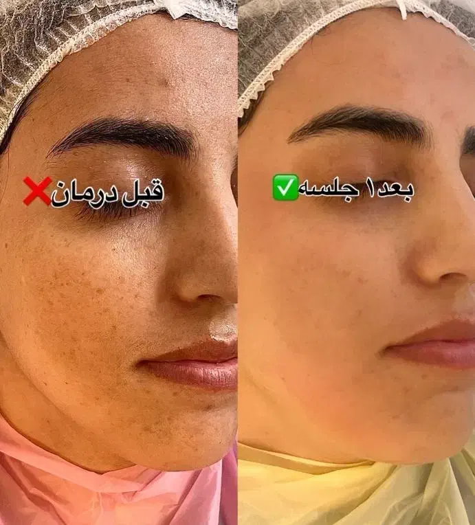 پاکسازی درمانی و تخصصی پوست برا خانم ها و آقایان|خدمات آرایشگری و زیبایی|کاشان, زیدی|دیوار