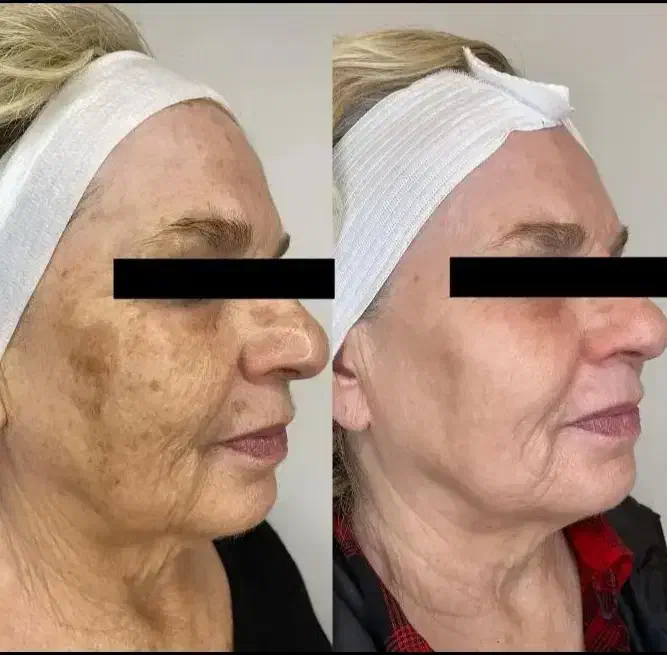 درمان تضمینی لک/کک و مک/ خال /فقط در 1جلسه|خدمات آرایشگری و زیبایی|اصفهان, لاله|دیوار